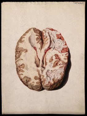 A diseased brain. Coloured stipple etching by W. Say after F. R. Say for Richard Bright, 1829.