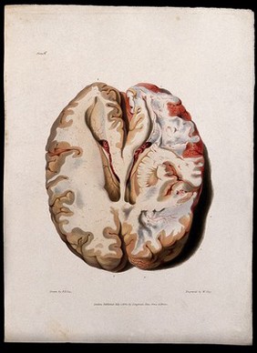 A diseased brain. Coloured stipple etching by W. Say after F. R. Say for Richard Bright, 1829.