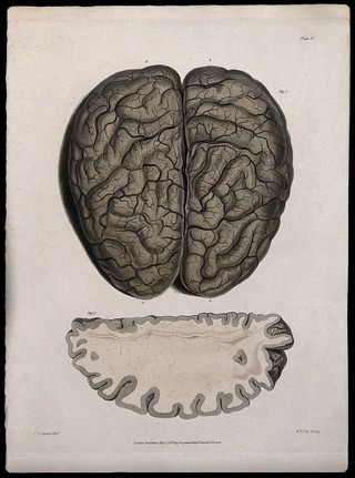 A dissected brain; and a section of diseased brain. Coloured stipple etching by W. T. Fry after C. J. Canton for Richard Bright, 1829.