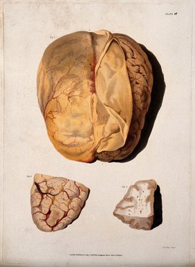 A dissected brain; and two sections of diseased brain. Coloured stipple etching by W. T. Fry for Richard Bright, 1829.