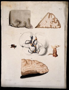 Six sections of diseased brain. Coloured stipple etching by W. T. Fry after F. R. Say & C. J. Canton for Richard Bright, 1830.