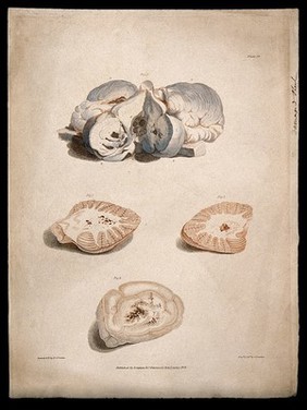 Four sections of diseased brain. Colour stipple etching by C. J. Canton after E. (?) R. Say for Richard Bright, 1829.