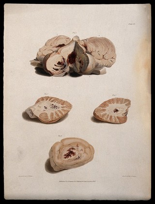 Four sections of diseased brain. Coloured stipple etching by C. J. Canton after E. (?) R. Say for Richard Bright, 1829.