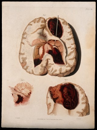 Three sections of diseased brain. Coloured stipple etching by W. T. Fry after F. R. Say for Richard Bright, 1829.