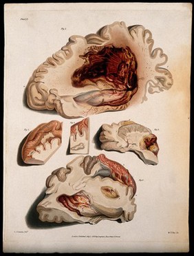 Five sections of diseased brain. Coloured stipple etching by W. T. Fry after C. J. Canton for Richard Bright, 1829.