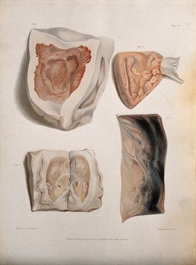 Four sections of diseased brain. Coloured stipple etching by W. T. Fry after C. J. Canton for Richard Bright, 1830.