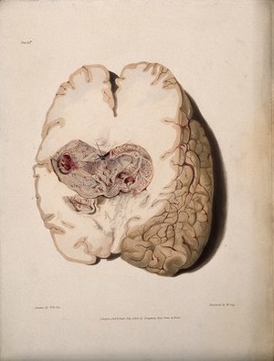 view A diseased brain. Coloured stipple etching by W. Say after F. R. Say for Richard Bright, 1829.