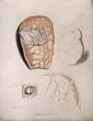 view Four sections of diseased brain. Colour stipple etching by C. J. Canton for Richard Bright, 1829.