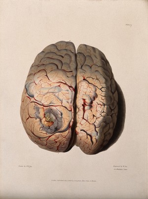 view A diseased brain. Coloured stipple etching by W. Say after F. R. Say for Richard Bright, 1829.