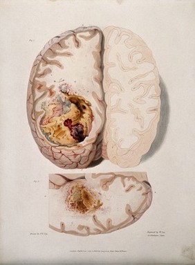 Two sections of diseased brain. Coloured stipple etching by W. Say after F. R. Say for Richard Bright, 1829.