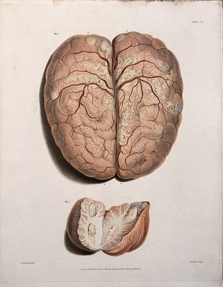 A diseased brain of an eleven year old child; and a section of it in detail. Coloured stipple etching by W. T. Fry after C. J. Canton for Richard Bright, 1830.