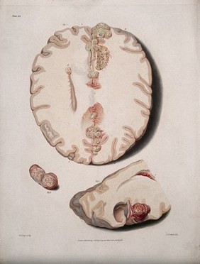 Three sections of diseased brain. Coloured stipple etching by W. T. Fry after C. J. Canton for Richard Bright, 1829.