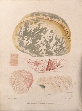 Four sections of diseased brain; and a section of spine. Colour stipple etching by W. Say after C. J. Canton after F. F. Giraud for Richard Bright, 1831.