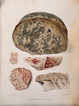 Four sections of diseased brain; and a section of spine. Coloured stipple etching by W. Say after C. J. Canton after F. F. Giraud for Richard Bright, 1831.