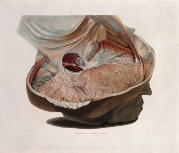 Dissected head of James Cardinal with top of skull removed to expose brain deformation. Coloured aquatint by W. Say after F. R. Say for Richard Bright, 1829.
