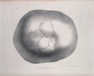 view The deformed skull of James Cardinal as viewed from above. Lithograph after G. Scharf for Richard Bright, 1830.