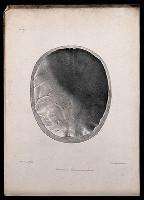 Inside the top half of a skull of an epileptic. Lithograph after G. Scharf for Richard Bright, 1830.