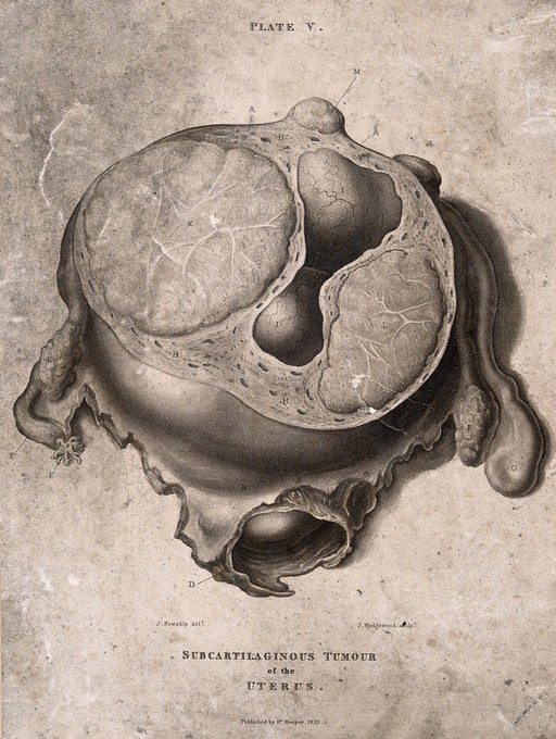 A diseased uterus, lettered for key. Etching by J. Wedgewood after J. Howship for Robert Hooper, 1829.
