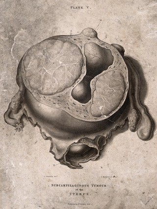 A diseased uterus, lettered for key. Aquatint by J. Wedgwood after J. Howship for Robert Hooper, 1829.