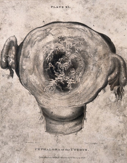 A diseased uterus, lettered for key. Etching by Thomas Heaphy after J. Howship for Dr. Robert Hooper, 1829.