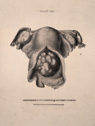A diseased uterus, lettered for key. Lithograph by T. Heaphy after J. Howship for Robert Hooper, 1829.