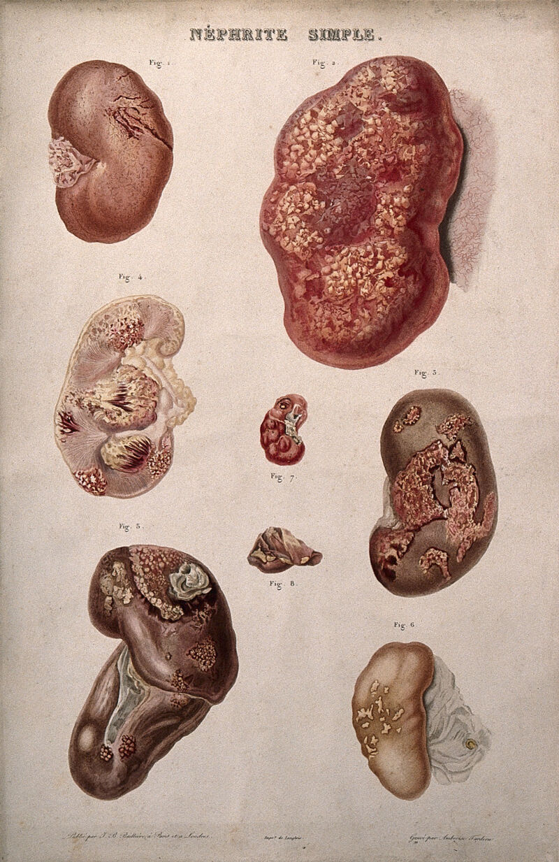 Several examples of diseased kidneys, numbered for key. Colour etching by Ambroise Tardieu for Rayer., by Ambroise Tardieu