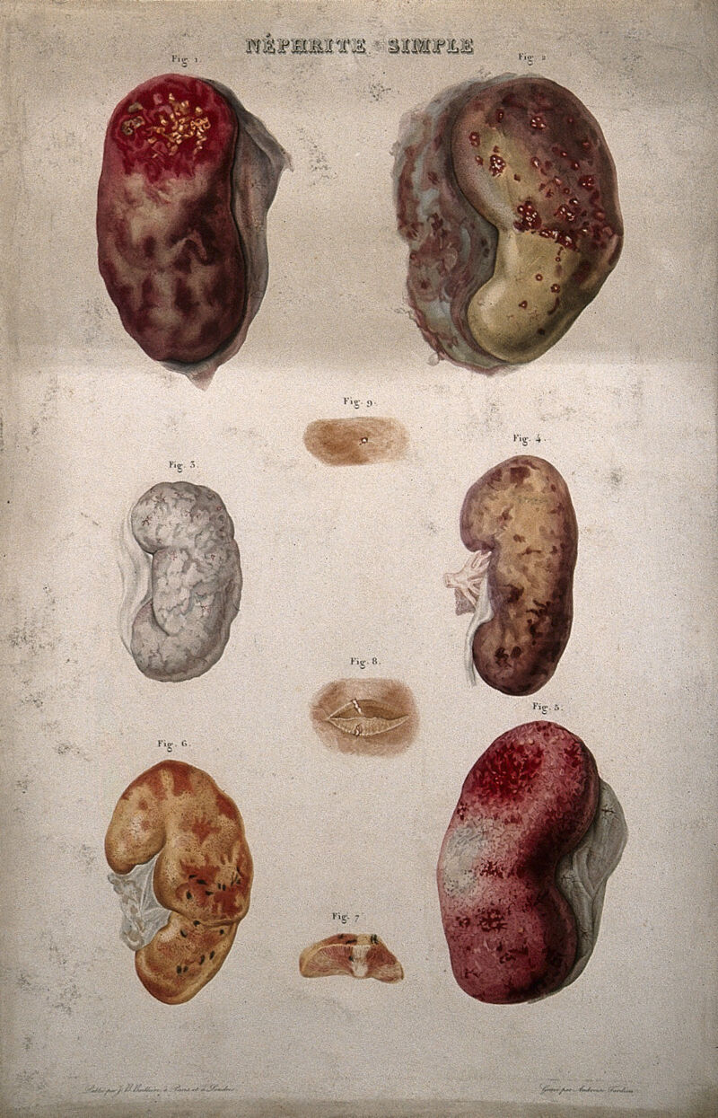 Several examples of diseased kidneys, numbered for key. Colour etching by Ambroise Tardieu for Rayer., by Ambroise Tardieu