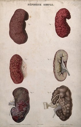 Several examples of diseased kidneys, numbered for key. Colour etching by Ambroise Tardieu for Rayer.