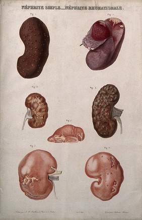 Several examples of diseased kidneys, numbered for key. Colour etching by Ambroise Tardieu for Rayer.