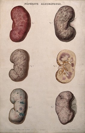 Several examples of diseased kidneys, numbered for key. Colour etching by Ambroise Tardieu for Rayer.