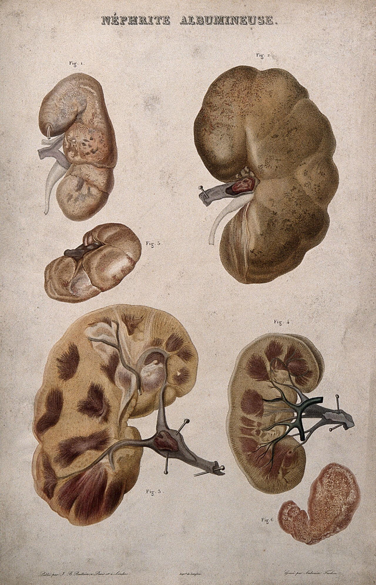 Several examples of diseased kidneys, numbered for key. Colour etching by Ambroise Tardieu for Rayer., by Ambroise Tardieu