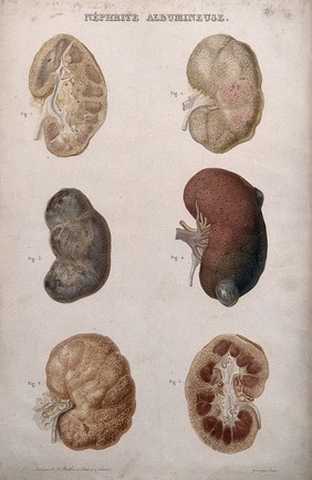 Several examples of diseased kidneys, numbered for key. Colour etching by Oudet for Rayer.