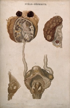 A disease causing inflammation of the kidneys and pelvis, numbered for key. Colour etching by Oudet for Rayer.