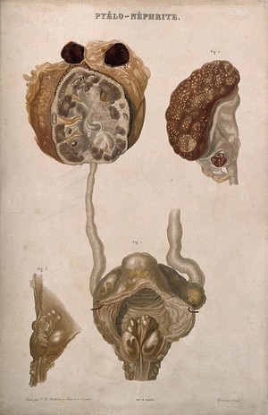 view A disease causing inflammation of the kidneys and pelvis, numbered for key. Colour etching by Oudet for Rayer.