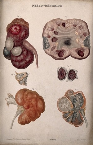 view Several examples of diseased kidneys, numbered for key. Colour etching by Oudet for Rayer.