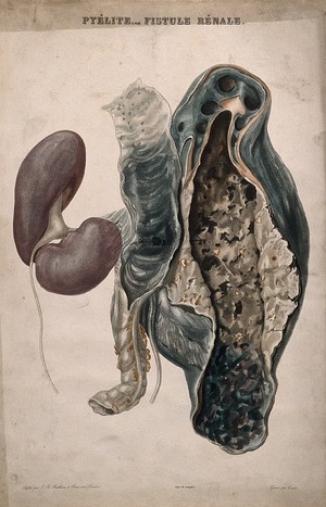 view A diseased kidney. Colour etching by Oudet for Rayer.