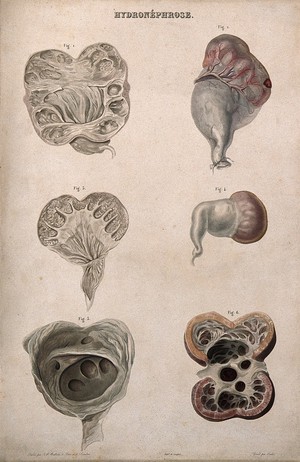 view Several examples of a disease of the kidney whereby the accumulation of urine in the kidney pelvic region results in distention and atrophy, numbered for key. Colour etching by Oudet for Rayer.
