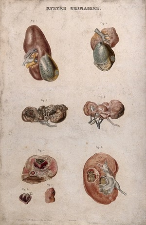 view Several examples of a disease of the kidney (urinary cysts), numbered for key. Colour etching by Oudet for Rayer.