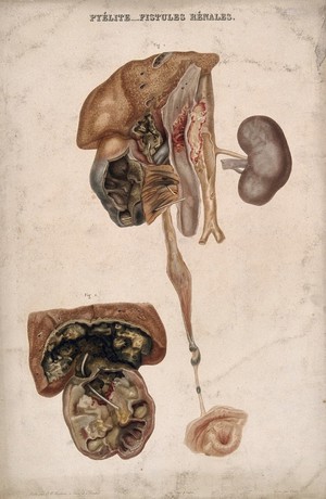 view Two examples of a disease of the kidney. Colour etching by Oudet for Rayer.