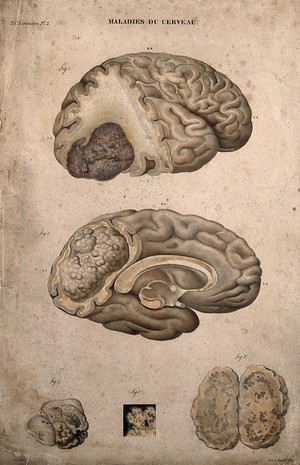 view Several sections of diseased brain, numbered for key. Coloured lithograph by Bénard et Frey after A. Chazal, c. 1825.