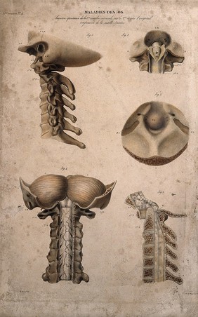 Five sections of diseased bone, numbered for key. Coloured lithograph by Bénard et Frey after A. Chazal, c. 1825.