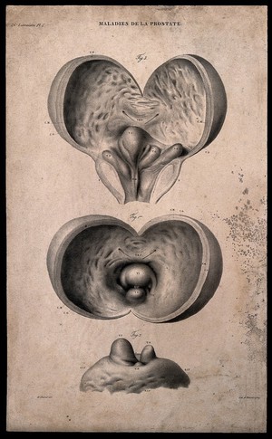 view Three sections of diseased prostate, numbered for key. Lithograph by Bénard et Frey after A. Chazal, c. 1825.