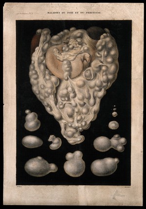 view Several sections of diseased liver. Coloured lithograph by Benard after A. Chazal, c. 1825.
