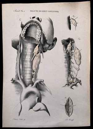 view Four examples of diseases of the throat, numbered for key. Lithograph by Ridolfi after Ottavio Muzzi, c. 1843.