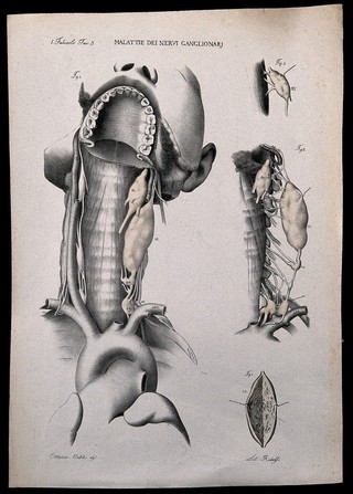 Four examples of diseases of the throat, numbered for key. Lithograph by Ridolfi after Ottavio Muzzi, c. 1843.