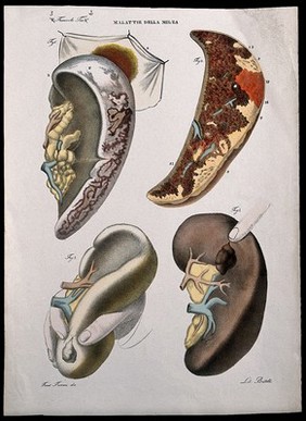 Four examples of diseased spleen, numbered for key. Coloured lithograph by Batelli after Ferdinando Ferrari, c. 1843.