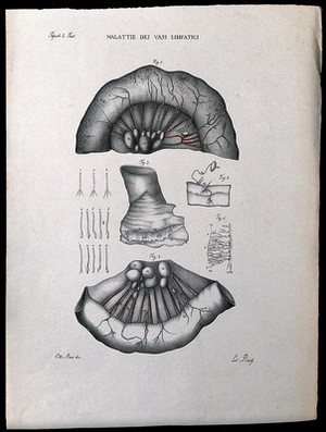 view Several sections of diseased lymph vessels, numbered for key. Coloured lithograph by Ridolfi after Ottavio Muzzi, c. 1843.