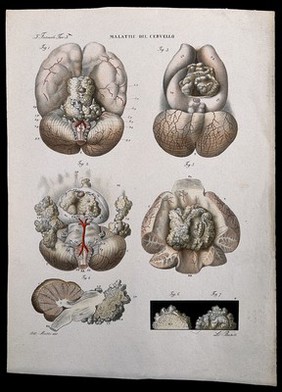 Several sections of diseased brain, numbered for key. Coloured lithograph by Batelli after Ottavio Muzzi, c. 1843.