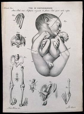 A deformed baby; and examples of skeletal deformity in detail, numbered for key. Lithograph by Batelli after Ferdinando Ferrari, c. 1843.