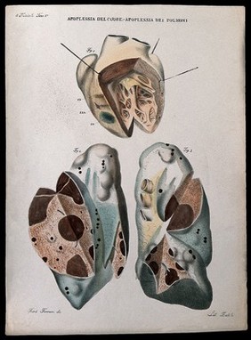 Three sections of diseased heart and lungs showing blood clots and haemorrhage, numbered for key. Coloured lithograph by Batelli after Ferdinando Ferrari, c. 1843.